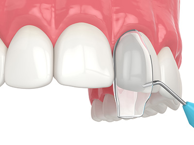 Dream Dental Group | Patital Dentures, Curodont and SureSmile   Aligners