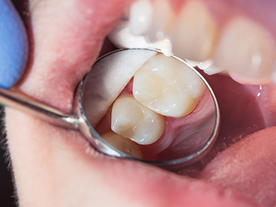 Dream Dental Group | Inlays  amp  Onlays, Dental Bonding and Full Mouth Reconstruction