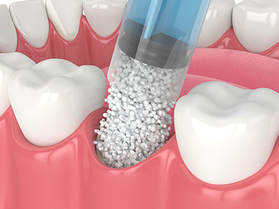 Dream Dental Group | Sleep Apnea, Snoring Appliances and Root Canals
