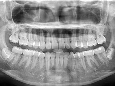 Dream Dental Group | Night Guards, SureSmile   Aligners and Teeth Whitening