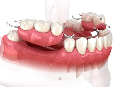 Dream Dental Group | Preventative Program, Oral Appliance Therapy and Bone Grafts