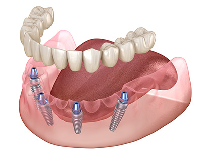 Dream Dental Group | Patital Dentures, TMJ Disorders and Retained Dentures