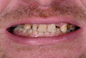 Dream Dental Group | Sleep Apnea, Fluoride Treatment and Oral Appliance Therapy