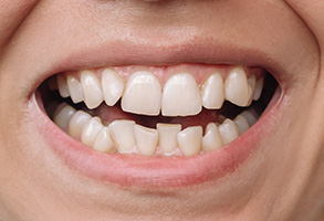 Dream Dental Group | Bone Grafts, Cosmetic Dentistry and TMJ Disorders