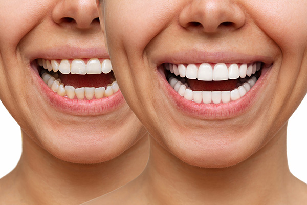 Dream Dental Group | Dental Sealants, Inlays  amp  Onlays and Sports Mouthguards