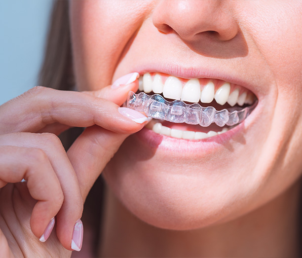 Dream Dental Group | Veneers, Night Guards and SureSmile   Aligners
