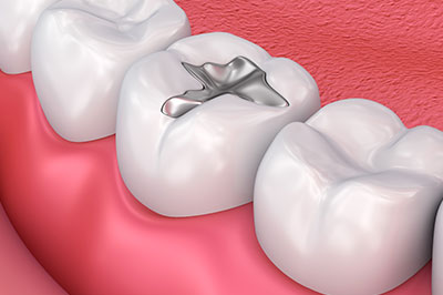 Dream Dental Group | Fluoride Treatment, Full Mouth Reconstruction and Oral Exams