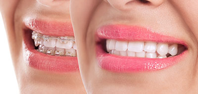 Dream Dental Group | SureSmile   Aligners, Snoring Appliances and Extractions