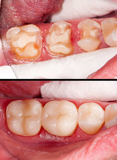 Dream Dental Group | Dental Fillings, Sleep Apnea and Night Guards
