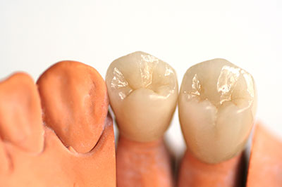 Dream Dental Group | Veneers, Dental Fillings and Snoring Appliances