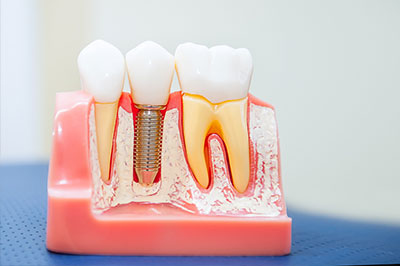 Dream Dental Group | Night Guards, Inlays  amp  Onlays and Patital Dentures