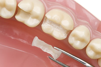 Dream Dental Group | Ceramic Crowns, Dental Bridges and Sleep Apnea
