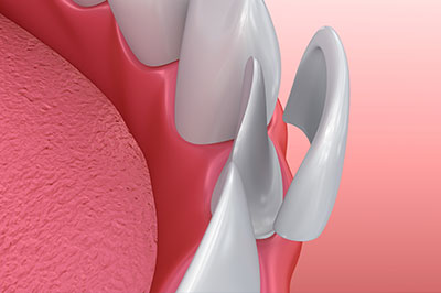 Dream Dental Group | Dental Sealants, Inlays  amp  Onlays and Sports Mouthguards