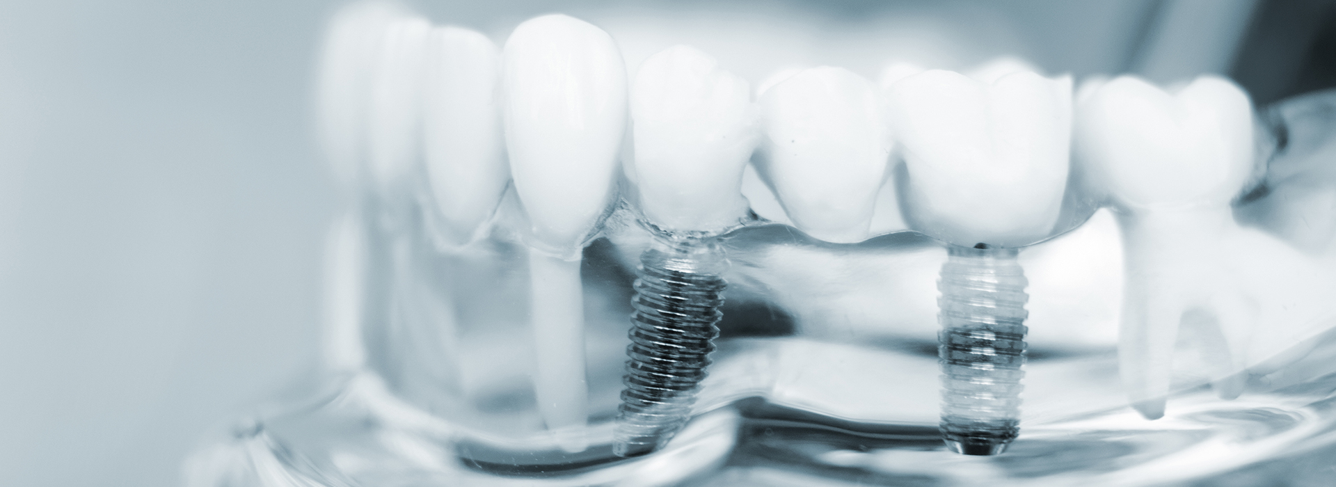 Dream Dental Group | Pediatric Dentistry, Inlays amp Onlays and Night Guards